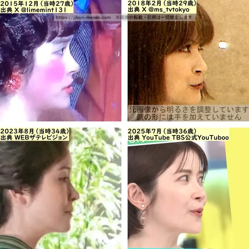 宮澤エマの鼻の整形検証2015年～2025年（横顔）