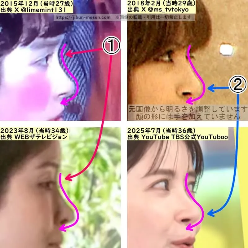 宮澤エマの鼻の整形検証2015年～2025年（横顔・拡大）