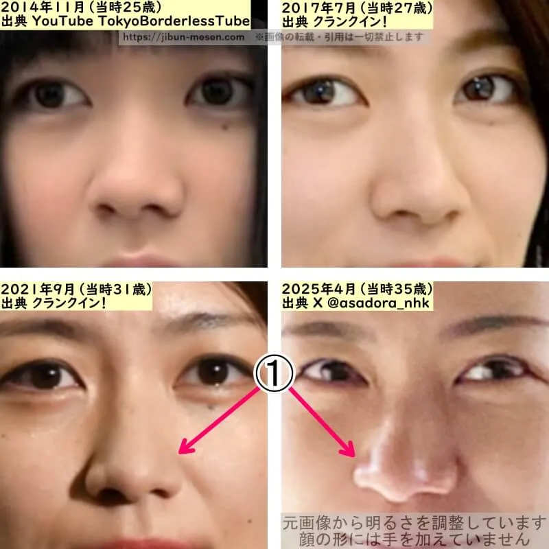 瀧内公美の鼻の整形検証2014年～2025年（拡大）