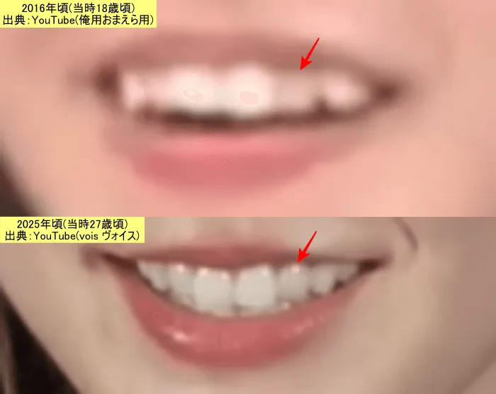 加藤史帆の18歳当時の口元【上】と27歳当時の口元【下】