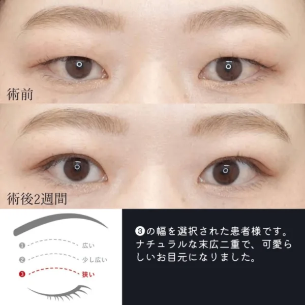 二重埋没法による目の整形例（出典：水の森美容クリニック公式サイト）