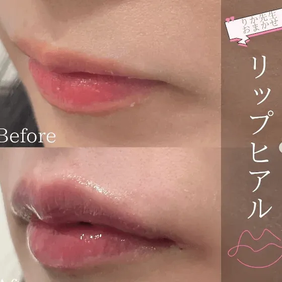 ヒアルロン酸注射による唇の整形例の画像（出典：渋谷あおぞらクリニック公式サイト）