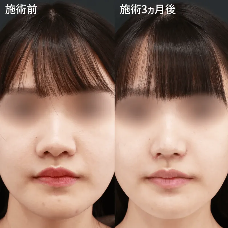 小鼻縮小術による鼻の整形例の画像　出典：TAクリニックグループ公式サイト
