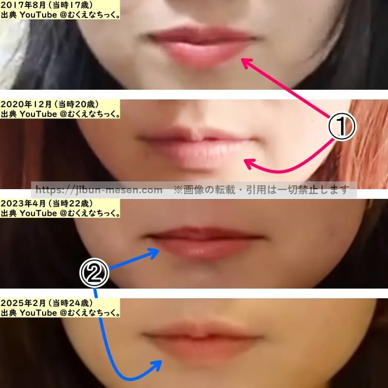 むくえな むくの唇の整形検証2017年～2025年（拡大）