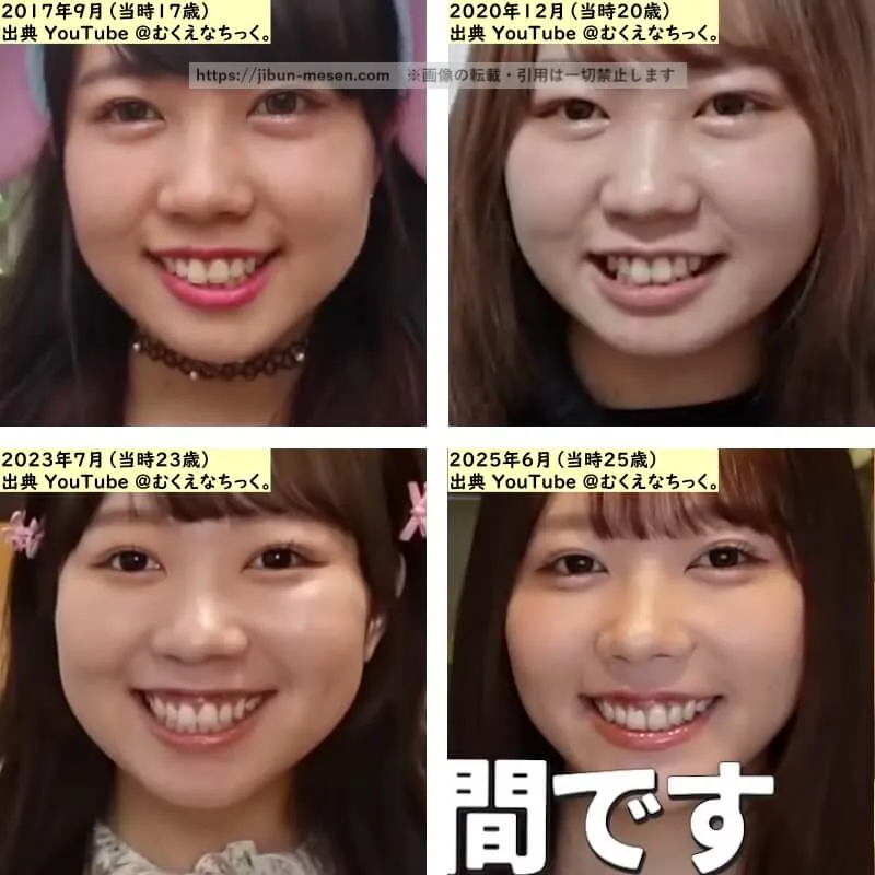 むくえな むくの鼻の整形検証2017年～2025年