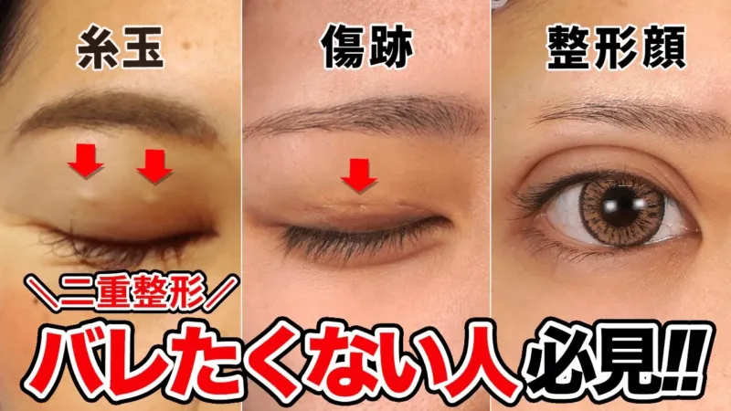 二重整形の痕跡（出典：湘南美容クリニック公式サイト）