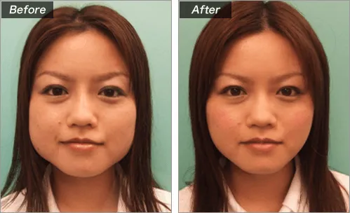 エラボトックス注射による顔の整形例（出典：城本クリニック公式サイト）