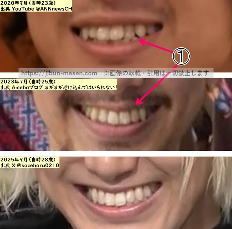 藤井風の歯並びの比較2020年～2025年の画像