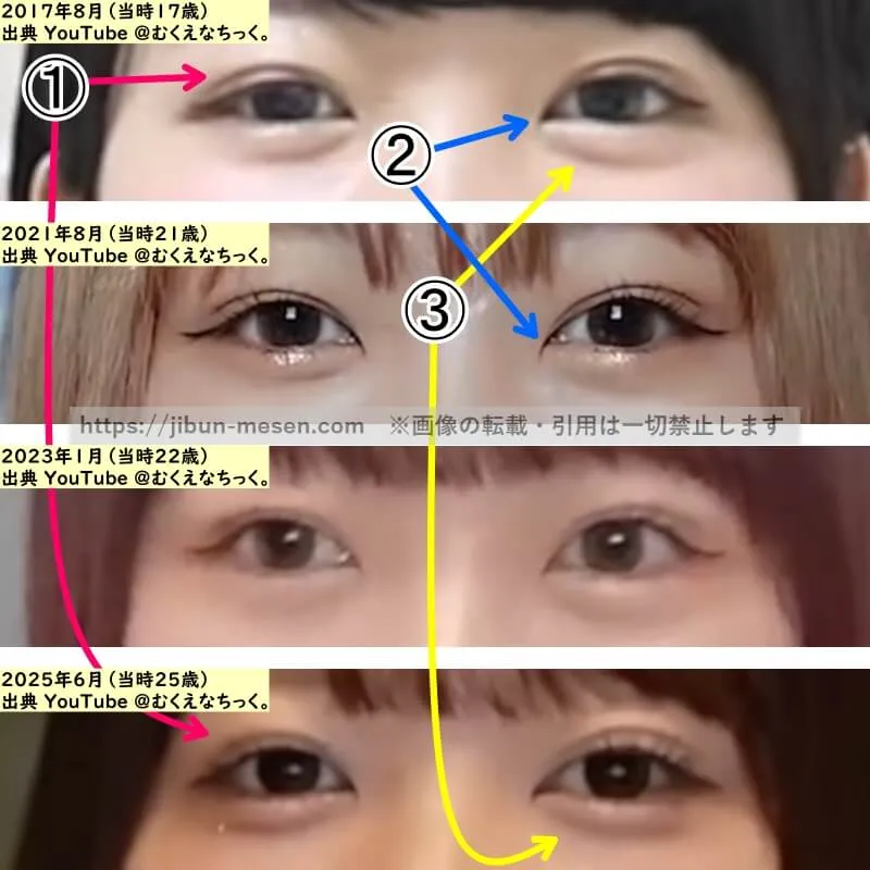 むくえな むくの目の整形検証2017年～2025年（拡大）