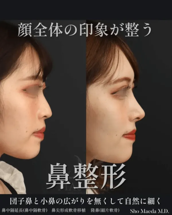 鼻整形の症例写真（出典：マエクリニック公式サイト）