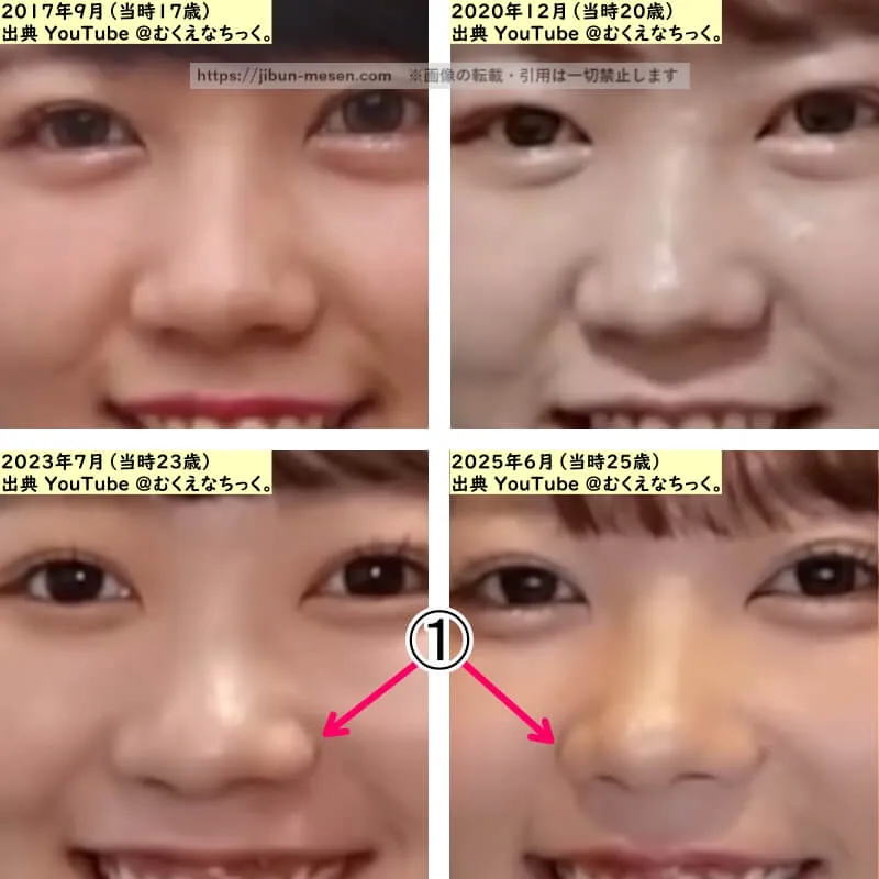 むくえな むくの鼻の整形検証2017年～2025年（拡大）