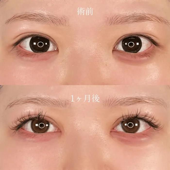 目頭切開による目の整形例（出典：アストラビューティークリニック公式サイト）
