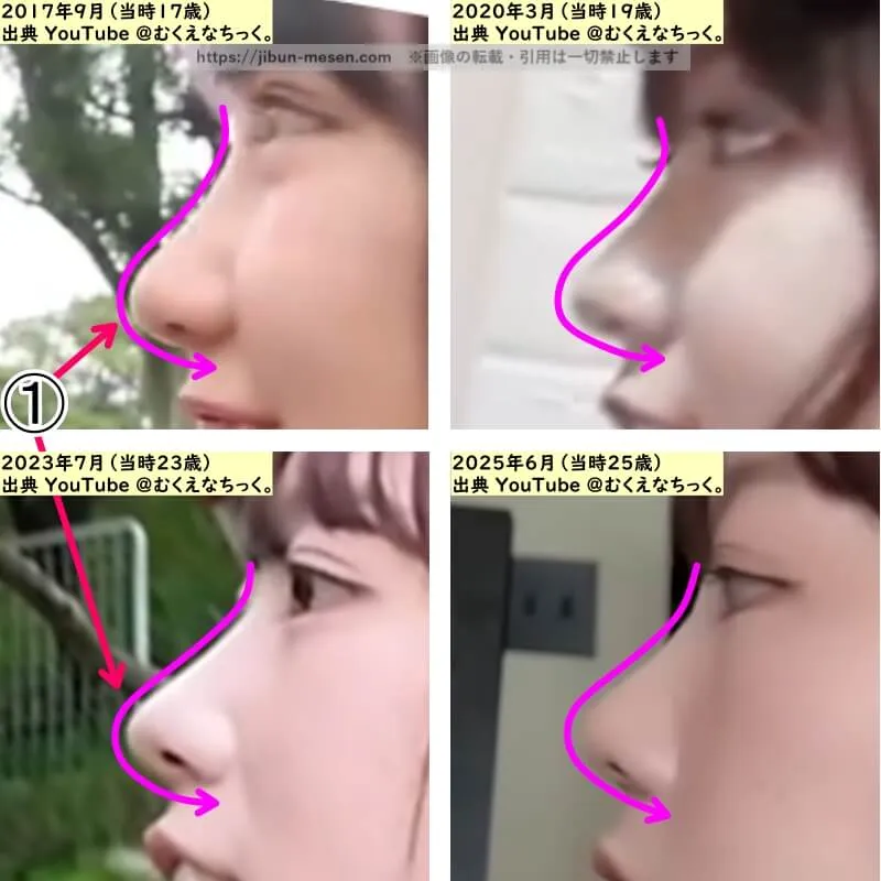 むくえな むくの鼻の整形検証2017年～2025年（横顔・拡大）