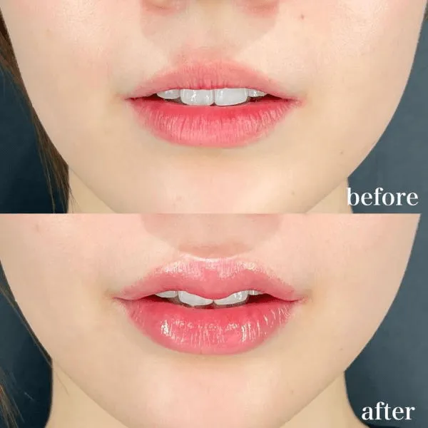 ヒアルロン酸注射による唇の整形例（出典：マエクリニック公式サイト）