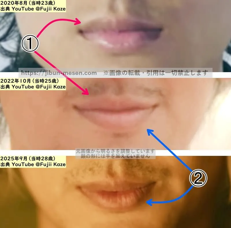 藤井風の唇の整形検証2020年～2025年（拡大）の画像