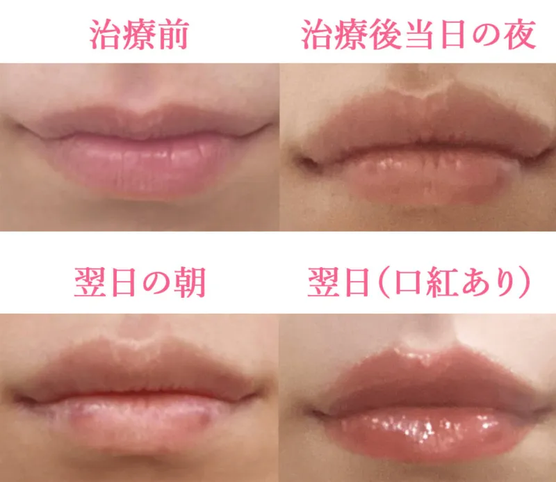ヒアルロン酸注射による唇の整形例（出典：マグノリア皮膚科クリニック公式サイト）