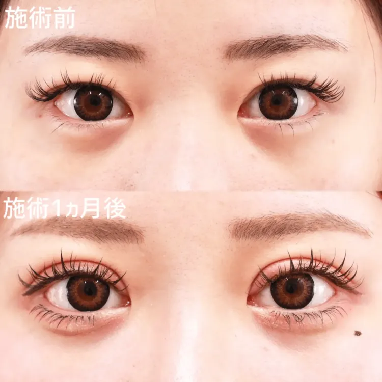 二重切開法による目の整形例（出典：TAクリニックグループ公式サイト）