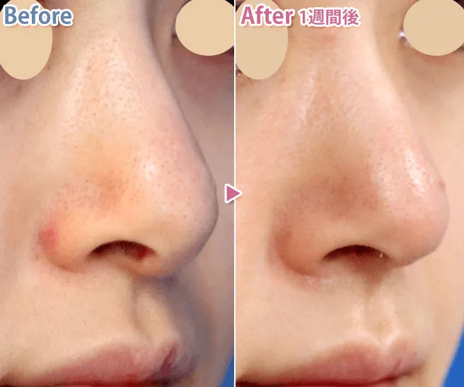 鼻柱挙上術による鼻の整形例（出典：あつぎ美容クリニック公式サイト）の画像