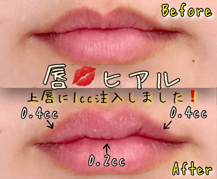 ヒアルロン酸注射による唇の整形例（出典：銀座フェイスクリニック公式サイト）の画像