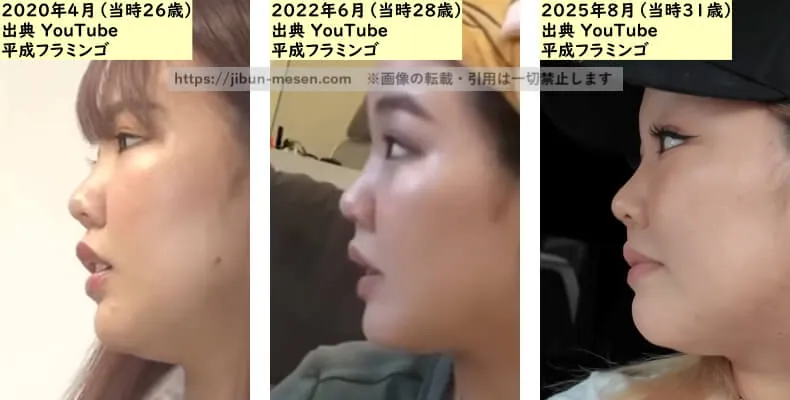 りほ（平成フラミンゴ）の鼻の整形検証2020年～2025年（横顔）の画像