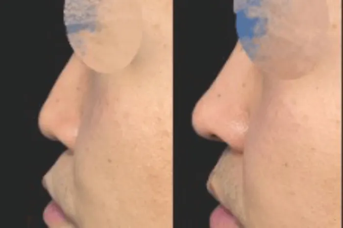 鼻尖形成術による鼻の整形例（出典：東京美専クリニック公式サイト）の画像