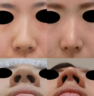 小鼻ボトックス注射による鼻の整形例（出典：もとび美容外科クリニック公式サイト）の画像