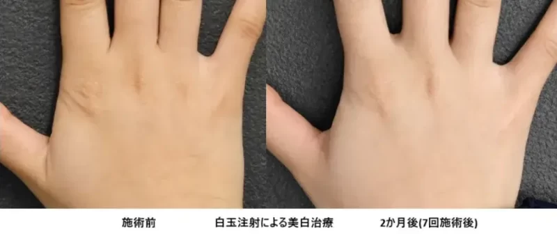 白玉注射による美白治療例の画像