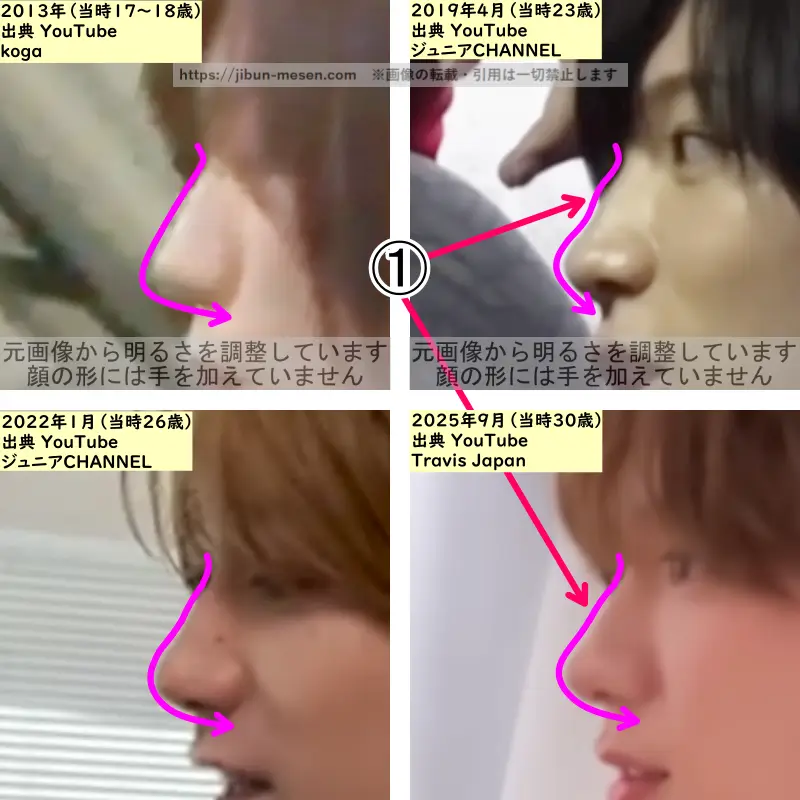 七五三掛龍也の鼻の整形検証2013年～2025年（横顔・拡大）の画像