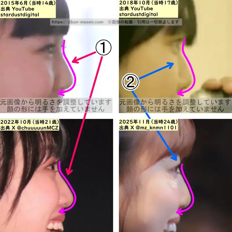 吉川ひよりの鼻の整形検証2015年~2025年(横顔・拡大)の画像