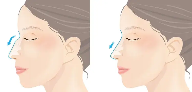 わし鼻・段鼻修正のイメージの画像