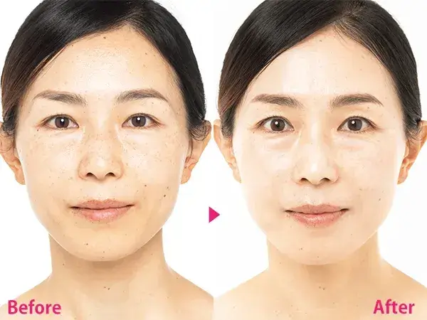 美白クリームのビフォーアフターの画像