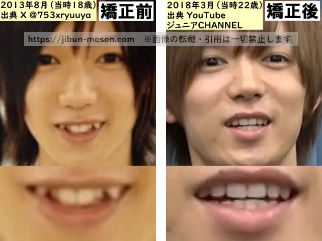 七五三掛龍也の歯列矯正の比較の画像