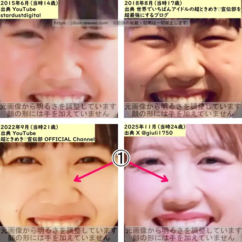 吉川ひよりの鼻の整形検証2015年~2025年(拡大)の画像