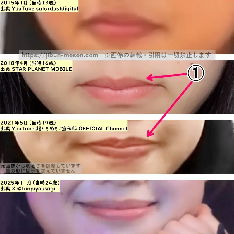 吉川ひよりの唇の整形検証2015年~2025年(拡大)の画像