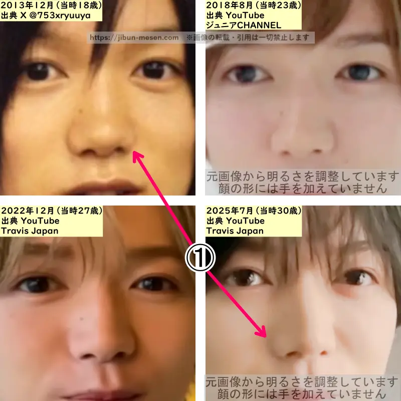 七五三掛龍也の鼻の整形検証2013年～2025年（拡大）