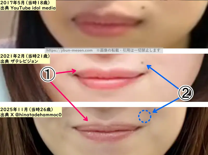 松田好花の唇の整形検証2017年～2025年（拡大）の画像