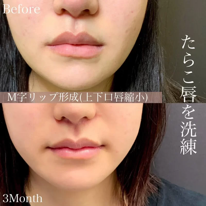 口唇縮小術による唇の整形例
