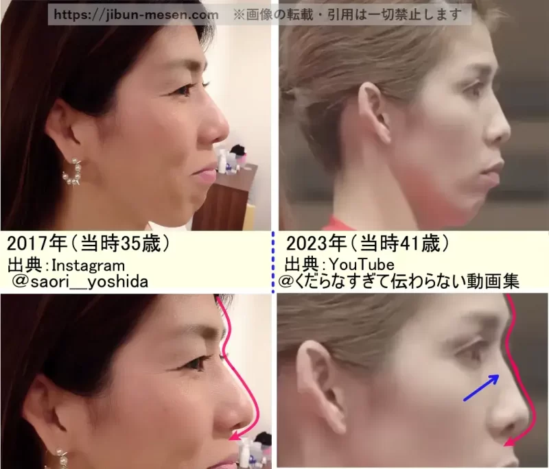 吉田沙保里の鼻の整形検証2017年～2023年（横顔）の画像