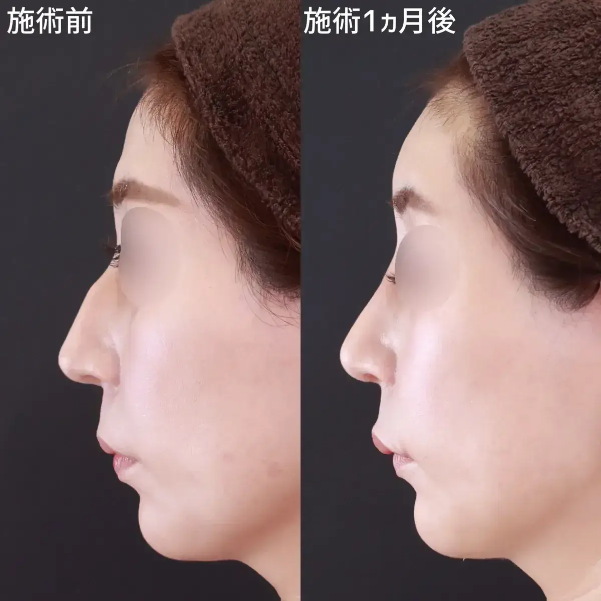 鼻プロテーゼによる鼻の整形例