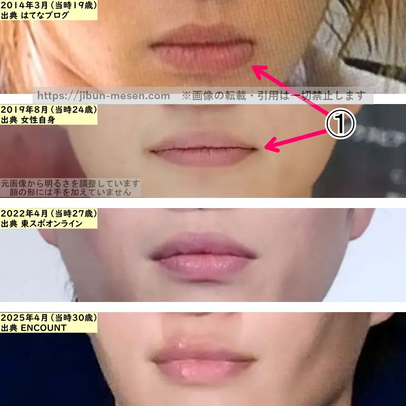 菊池風磨の唇の整形検証2014年～2025年（拡大）の画像