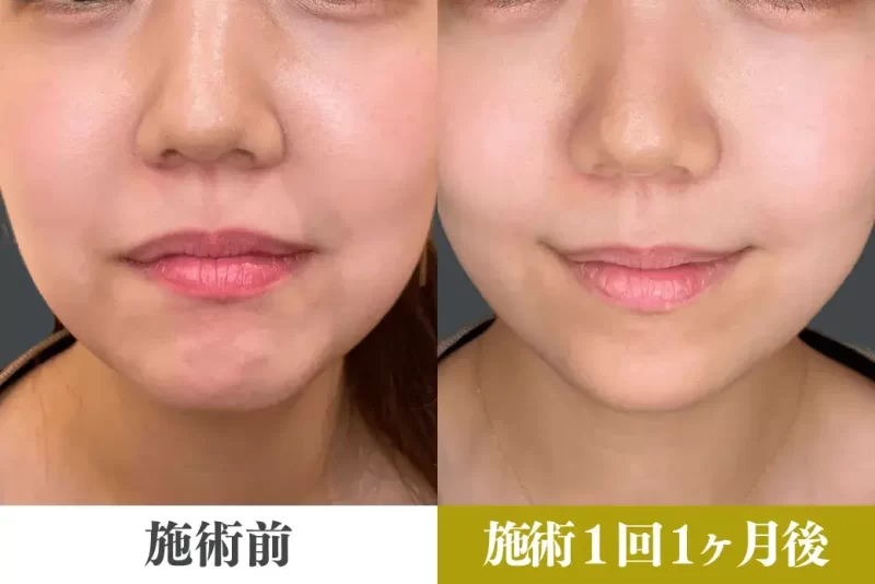 口角挙上による唇の整形例の画像