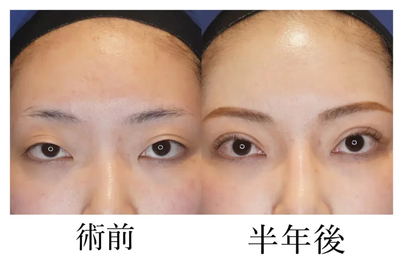 目頭切開の症例写真の画像