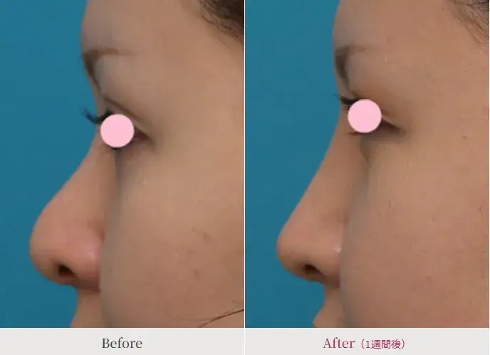 鼻シリコンプロテーゼを入れた症例写真の画像