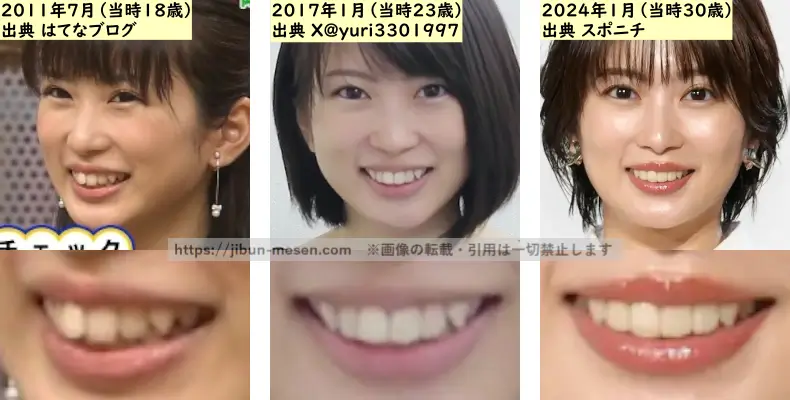 志田未来の歯並びの変化2011年～2024年の画像