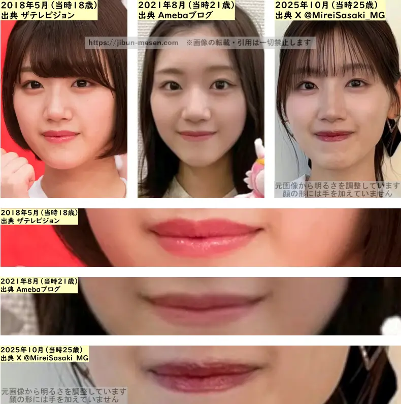 佐々木美玲の唇の整形検証2018年～2025年の画像